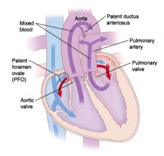 When the aorta and pulmonary trunk switch positions.