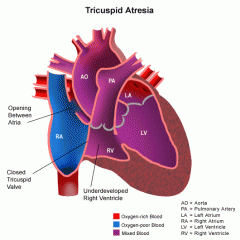 1) Pressure builds in the Right atrium
2) Right atrium becomes enlarged
3) Right ventricle suffers HYPOplasia
4) PDA develops to connect to pulmonary cirulation