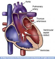 1) Pulmonary artery and aorta don't divide completely
2) Ventricles don't divide completely
3) There is one common valve with 4 cusps.