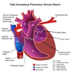 1) Pulmonary veins are not connected to Left atrium
2) To function, blood needs an ASD or VSD to move through.