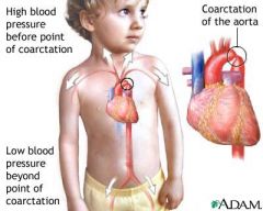 1) Obstruction occurs in the aorta
2) Compromised flow and lower pressure to lower extremities