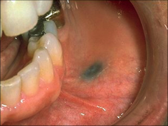 also called focal argyrosis, occur because of amalgam particles becoming imbedded within the tissue