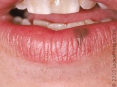 occurs on the lips, focal pigmented lesion