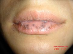 an acquired, benign, macular hyperpigmentation of the lips and oral mucosa, as well as the nails