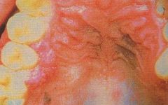 melanomas that are light in color and blend into the surrounding tissue