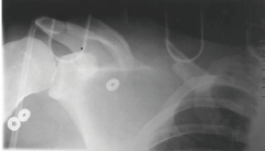 A patient presents with a swollen shoulder, pain and paraesthesia in the right arm as well as absent right radial and brachial pulses. He was sent to trauma following a road traffic collision. The X-ray is shown. State what you see on the X-ray a...
