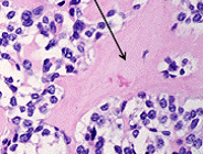 Nests of neuroendocrine cells
Amyloid Stroma (picture)