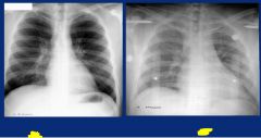 Chest radiograph direction