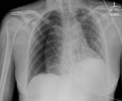 Pneumothorax (collection of air between visceral and parietal pleura)

Displaces the heart, compressing blood supply and causing cardiac arrest

May result from trauma or central line placement (subclavian vein near pleura)

Air hides shadow...