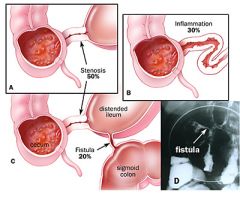 1. fistulae- between colon and other segments of the intestine (enteroenteral), bladder (enterovescial), vagina (enterovaginal), and skin (enterocutaneous)
2. anorectal disease (in 30% of patients)- fissures, abscesses and perianal fistulas
3. S...