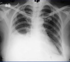 Pleural effusion

Liquid collects first in the costophrenic angles due to gravity, may traverse upwards due to surface tension.  Appears white, loses sharp angles at bottom of lung.

Ultrasound good for localizing spot for chest tube due to th...