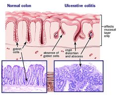 1. uninterrupted involvement of the rectum and/or colon - NO skip lesions
2. inflammation is no transmural as in crohn's-- it is limited to the mucosa, and submucosa
3. PMNs accumulate in the crypts of the colon (crypt abscesses)