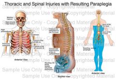 paraplegic defined at what level in spine?
