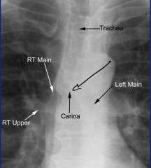 Right bronchus is wider and shorter than left

Endotracheal tube should be 5cm above carina, can find carina by drawing 45 degree line from aorta.  If it falls into a bronchus (more often the right due to size) it will collapse the opposite lung.