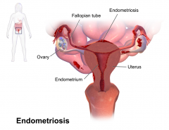 Endometriosis can implant where? 