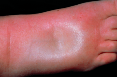Severe diffuse s/c oedema, a finger pushed into the expanded interstitium leaves an indentation