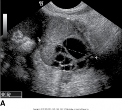 Is this an image of bilateral or unilateral ovarian carcinoma? 