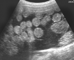 Numerous Intracystic
Floating Balls as a Sonographic Feature of Benign Cystic Teratoma called _________. 