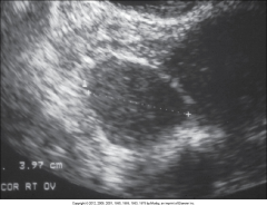 A 46-year-old woman was found to have a
grapefruit-sized mass on pelvic examination. Sonography showed a well-defined,
homogenous mass in the right ovary, which was surgically removed. This mass is known as ________  