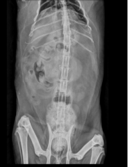 impaction
mechanical obstruction
mural disease
-stricture
extramural tumor
narrowed pelvic canal