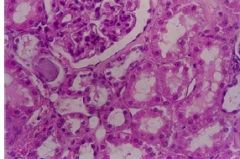 What has happened to some of the kidney cells/tubules pictured here