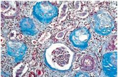 What has happened to the kidney cells here, and what types of cells have caused this