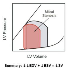 Mitral valve stenosis, left atrial pressure higher than 15, blood builds up against stiff mitral valve and not as much is pushed through.  Pressure gradient is higher than left ventricular pressure during diastole.

S1 may be louder due to closu...