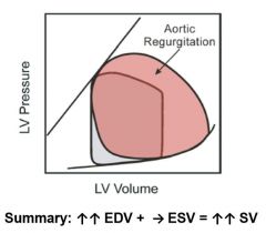 Aortic Valve regurgitation.  No pressure gradient, however pressure is still high.  Blood leaks back and increases EDV, larger fall off of aortic pressure during diastole.

Murmur begins with diastole and is described as a decrescendo.