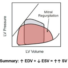 Mitral regurgitation.  No pressure gradient but heightened left atrial pressure.  Mitral valve leaks allowing blood back into left atrium, extra blood increases EDV which increases SV.  More complete emptying of the heart decreases ESV also increa...