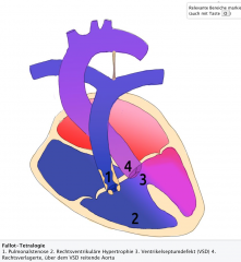 - 1. Pulmonalstenose (valvulär und/oder infundibulär) mit möglicher Hypoplasie der zentralen Pulmonalgefäße
- 2. Rechtsventrikuläre Hypertrophie
- 3. Ventrikelseptumdefekt (VSD)
- 4. Rechtsverlagerte, über dem VSD reitende Aorta