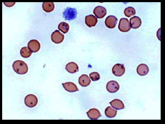 Mycoplasma hemofelis is aka ________ and is treated with?