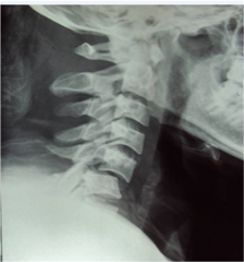 35 yo M s/p MVA and sustains the neck inj Fig, PE = w/ Brown-Sequard SCI. Which represents the motor & sensory findings? 1-b/l UE  loss of motor & unilateral LE loss of pain & temp; 2-b/l loss of motor func & unilateral loss of pain and temp 3-Ips...