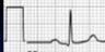Standard for 1mV set at beginning of each EKG, usually 10mm.  Sometimes 1/2 standard for very high deflections.

Speed of paper can also vary