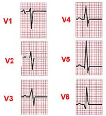 less than .1 seconds, variable amplitude

conduction disturbance = wider than normal
ventricular hypertrophy = taller than normal

Q wave = normally from septal fascicle 

V1/2 = negative, V3/4 = biphasic, V5/6 = positive
If 1/2 are positi...