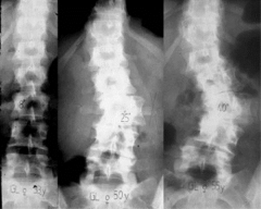 53 yo F is seen in the adult spine clinic for long-standing LBP. Hx untreated scoli as a child. Her xrays Fig A & B. Due to discomfort w/ ADLs & progressive pain, surgical intervention is planned. Which of the following factors would increase her ...