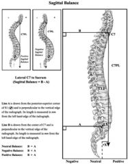adult pts w/ scoli, severity of sx correlates w/ which of the following variables? 1-Coronal imbalance; 2-Sagittal imbalance; 3-Magnitude of coronal Cobb angle 4-# of spine levels involved in the deformity; 5-Level of the apex of the curve