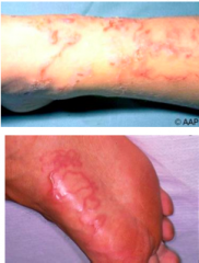 Name this skin condition, the causative organism, epidemiology, and diagnosis. 