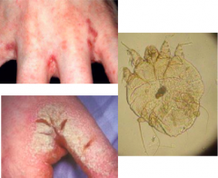 Name this skin condition, the causative organism, epidemiology, and diagnosis. 