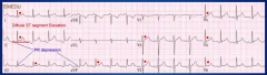 Dynamic (like rub)

ST segment elevation 
- Diffuse (not in leads aVR, V1)
- Occasionally focal (trauma and post-op)
- ST segment concave
- No reciprocal changes

Upright T waves

*PR depression (elevation in aVR) - may be the only ECG f...