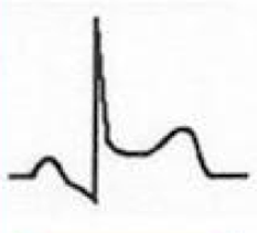 What does this EKG represent? Features?