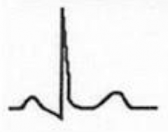 Stage II of Pericarditis
- ST segments normalize, w/ J point returning to baseline
- T-wave amplitude begins to decrease
- PR depression (which may make it appear as though there is continued ST elevation)