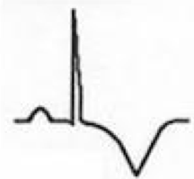 - T wave inversions develop diffusely (may be quite deep)
- No PR depression or ST elevation