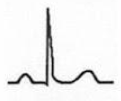 Stage IV of Pericarditis
- EKG abnormalities again normalize
- T-wave inversions may become permanent