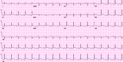 If you have a patient presenting w/ ST elevation on EKG, what should you do?