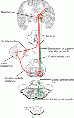 Common manifestation of ischemic stroke, often due to a lacunar mechanism. Mild upper motor neuron weakness but moderate to severe ataxia on the weak side. Impairment of both the cerebrocerebellar circuit and the corticospinal tract.