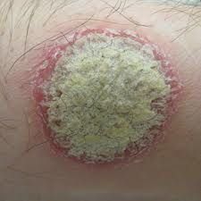 -treatment of psoriasis ranges from topical therapies to systemic treatment with conventional and biological drugs

-topical vitamin D analogs (calcipotriene, calcitrol, and tacalcitol) bind to the vitamin D receptor and inhibit keratinocyte pro...