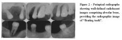 Radiolucent
Single or multiple lesions
Poorly defined
Teeth appear to be "floating in air"