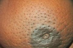 -Peau d'orange describes présence of pitting edema in subcutaneous breast tissue, accompanied by skin thickening around exaggerated hair follicles

-this pitting edema occurs when neoplastic cells plug the dermal lymphatic channels
