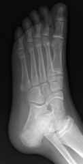 12 year old boy with left foot pain has the following x rays. What would you expect on physical exam with regard to range of motion?