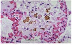 septa shouldn't have blood between them, alveoli should be clear.  Macrophages escape to eat the red blood cells, become full of pigment hemosiderin and are heart failure cells.